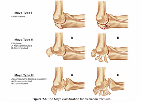 Phẫu thuật kết hợp gãy mỏm khuỷu cho bệnh nhân chấn thương sau tai nạn giao thông