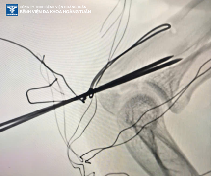 Phẫu thuật kết hợp gãy mỏm khuỷu cho bệnh nhân chấn thương sau tai nạn giao thông