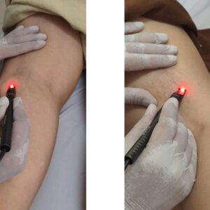 ĐIều trị giãn mao mạch bằng công nghệ Laser Diode 980nm